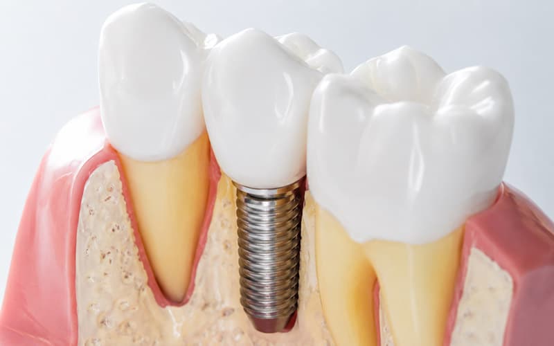Implantate